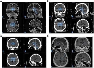 Periaqueductal/periventricular gray deep brain stimulation for the treatment of neuropathic facial pain